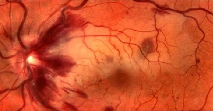 Blood vessels of the retina and vision residualization